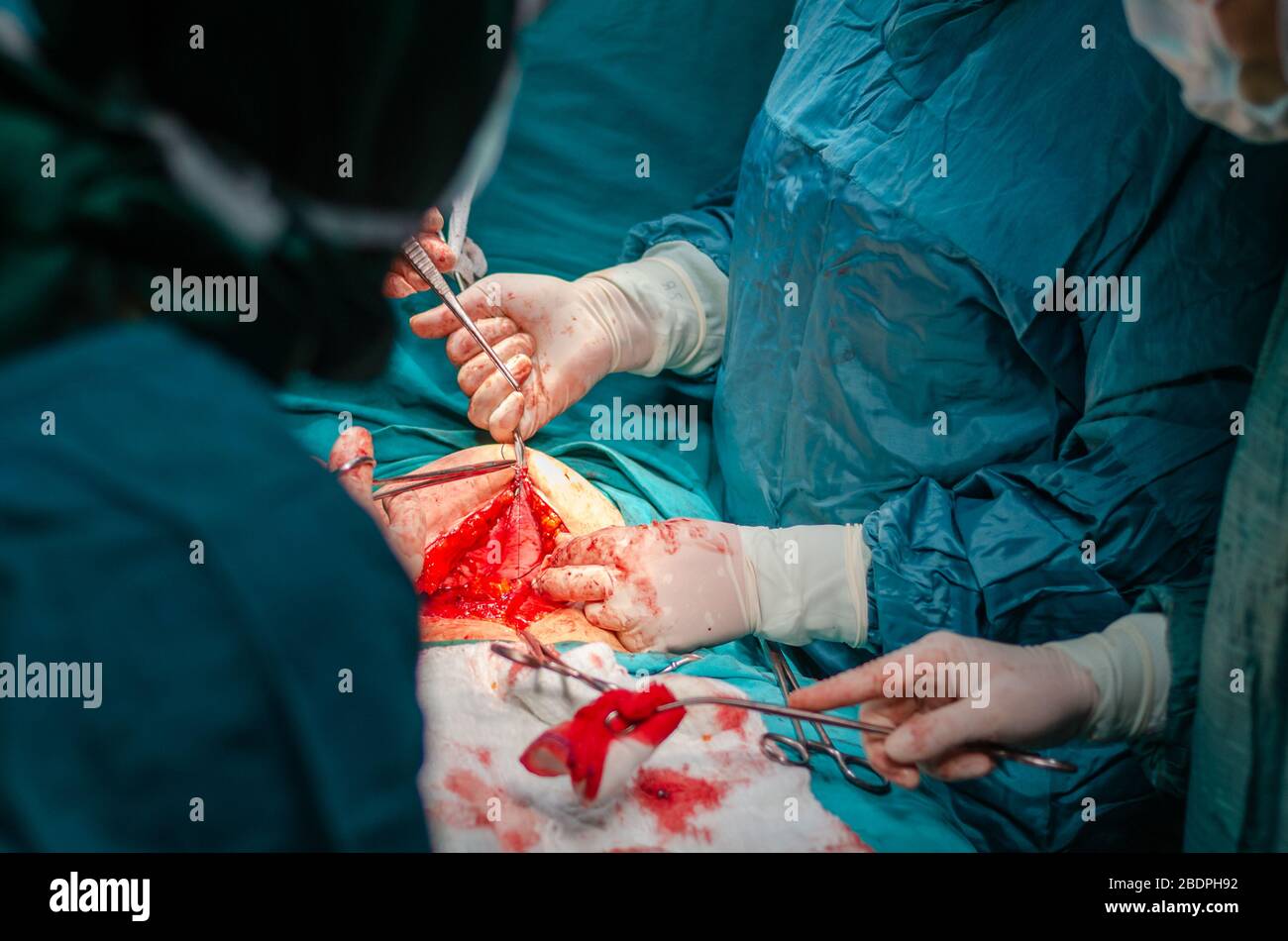 Assemblage des tissus abdominaux avec des points de suture en chirurgie d'hystérectomie Banque D'Images