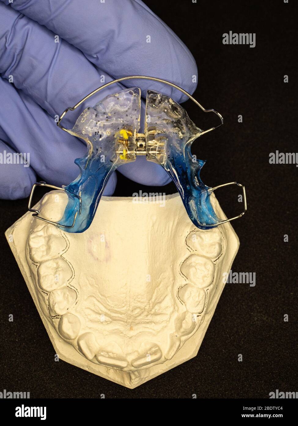 Réglage de test chez le dentiste des étrésillons palatales pour le jeune patient. La correction des mâchoires chez les jeunes est très populaire correction des malformations congénitales Banque D'Images