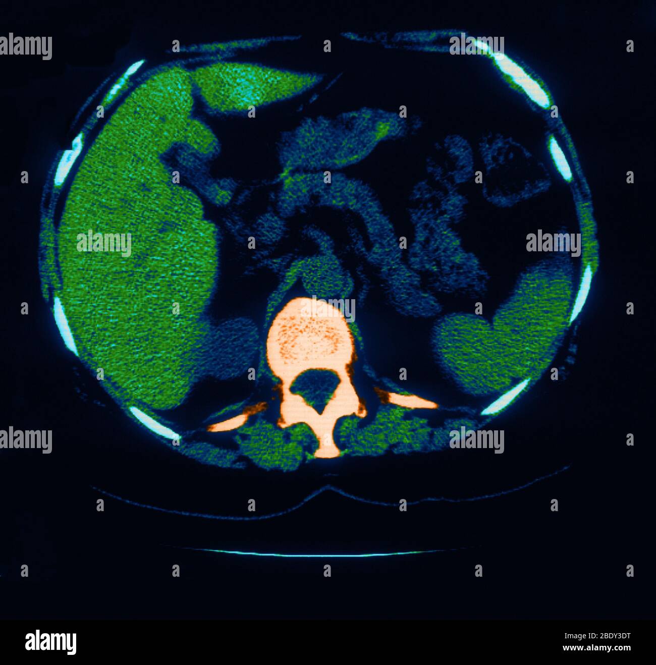 La scoliose, Granulome & la calcification dans Lung Banque D'Images