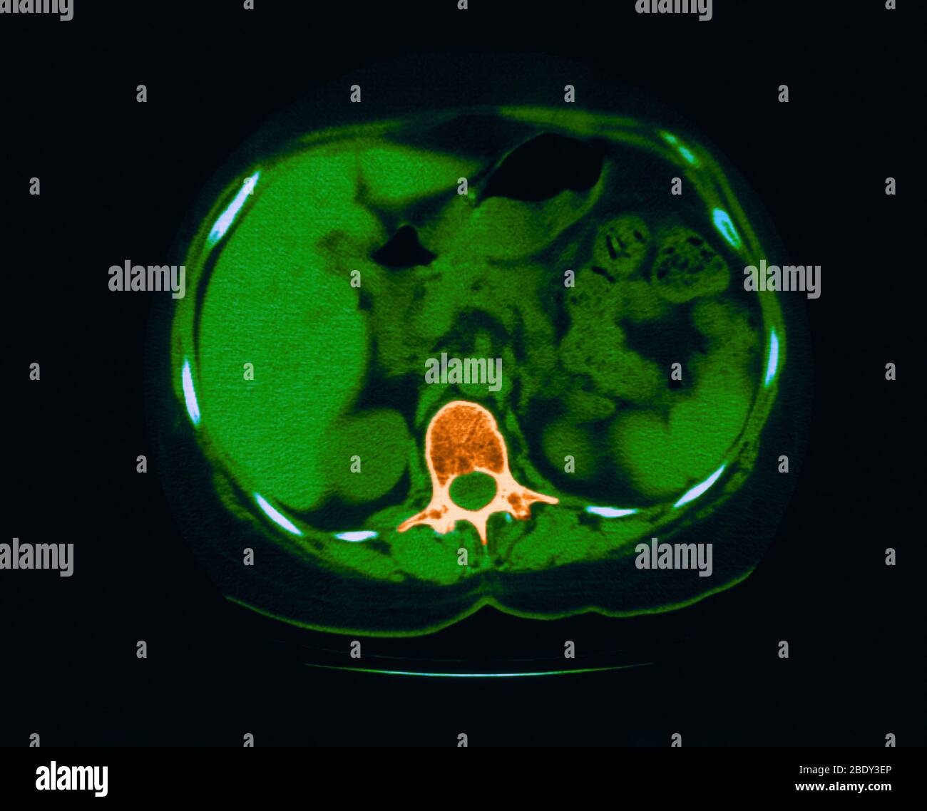 La scoliose, Granulome & la calcification dans Lung Banque D'Images