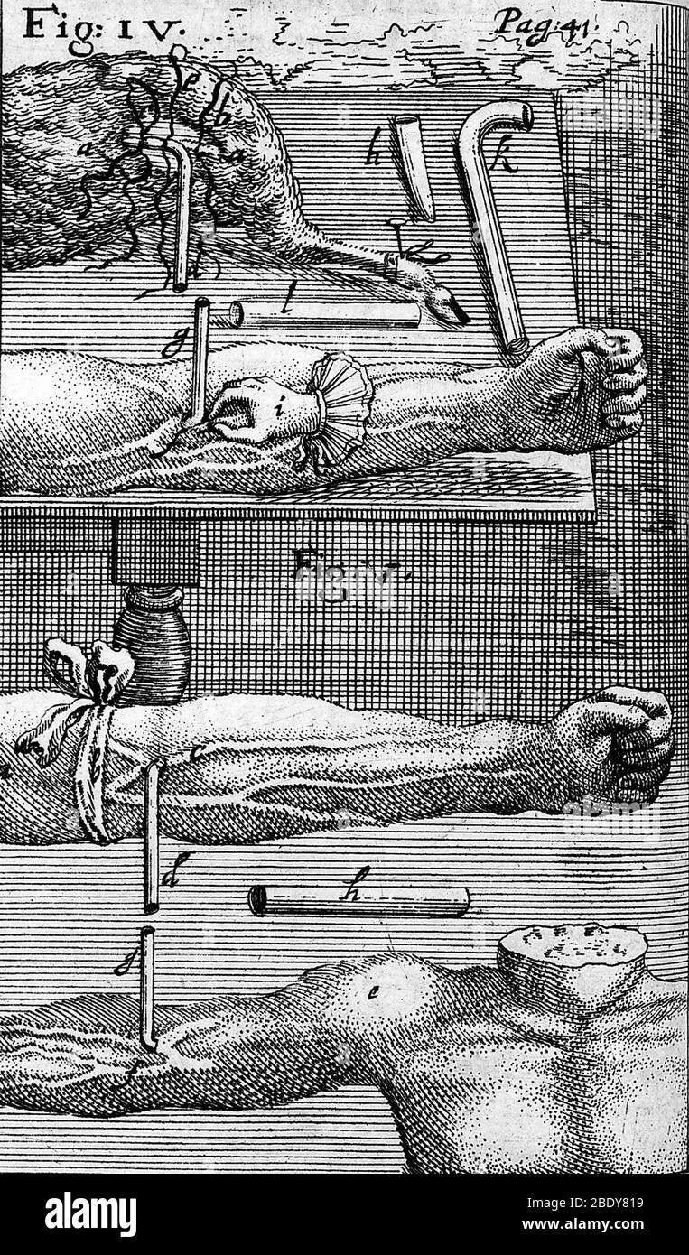 Techniques de transfusion sanguine, 1667 Banque D'Images