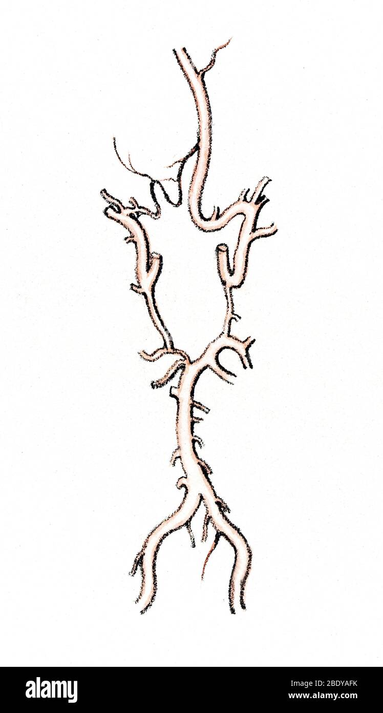 Artères à la base du cerveau, variation rare Banque D'Images