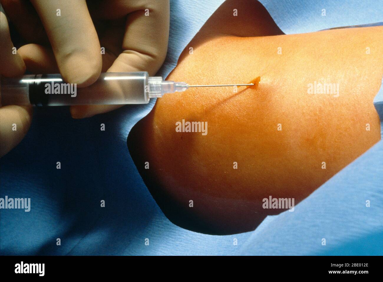 Implant contraceptif (1 sur 6) Banque D'Images
