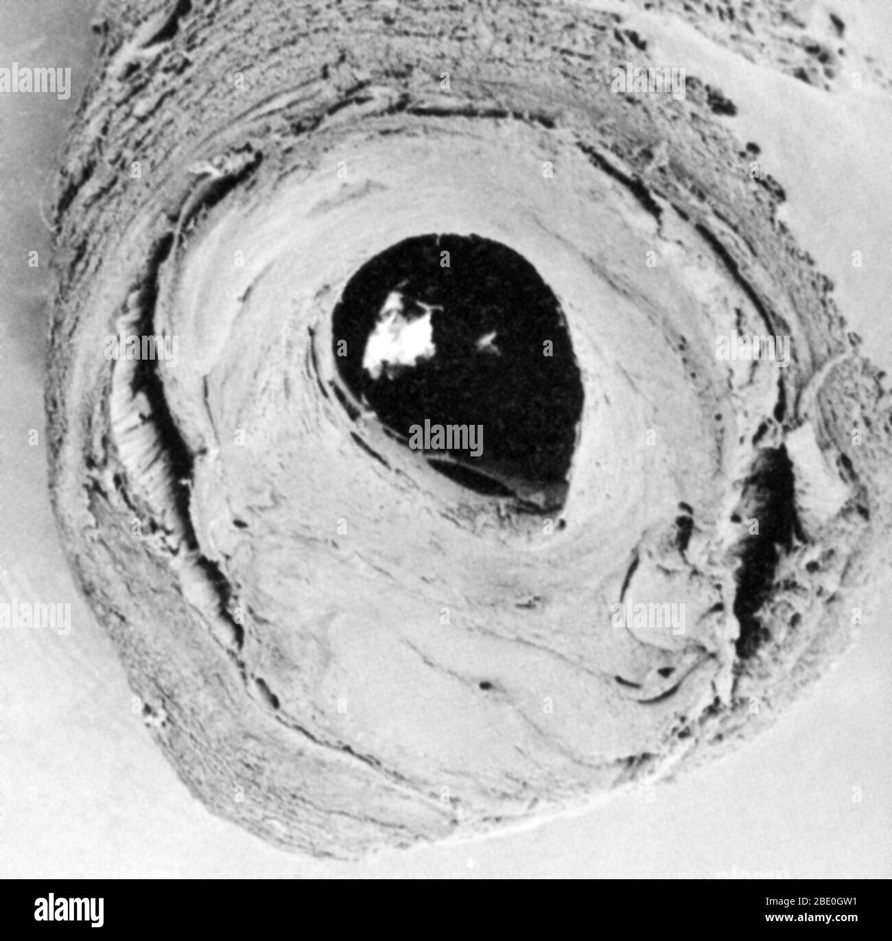 Étape de calcification des vaisseaux sanguins, illustrée en coupe. Ici, les dépôts de cholestérol ont réduit de trois quarts l'espace à l'intérieur du vaisseau sanguin, la lumière. Voir les modèles BP4527 et BP4528 pour d'autres dans la série. Banque D'Images