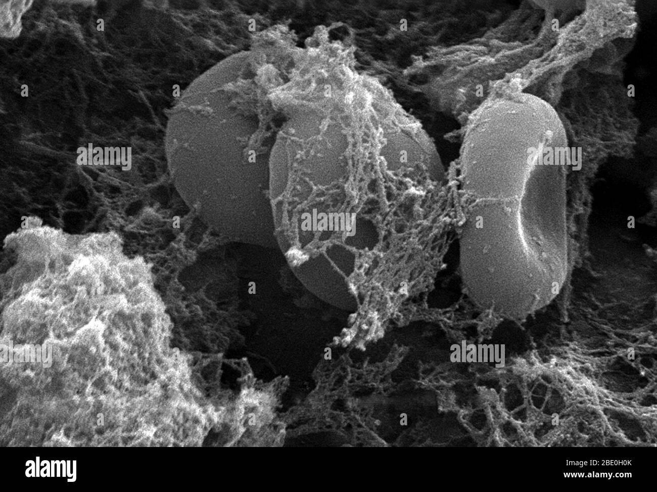 Ce micrographe électronique à balayage (SEM) a représenté une vue plus rapprochée du nombre de globules rouges trouvés enmaillés dans une matrice fibreuse sur la surface luminale d'un vasculaire à indwelling; agrandi 7766 fois. Dans ce cas, le cathéter d'endwelling était un tube qui était laissé en place créant un portail de brevet directement dans un vaisseau sanguin. Notez la forme cytomorphologique biconvexe de chaque érythrocyte, qui augmente la surface de ces cellules remplies d'hémoglobine, favorisant ainsi un plus grand degré d'échange de gaz, qui est leur fonction principale dans un cadre in vivo. Dans leur phase adulte, ces cellules po Banque D'Images