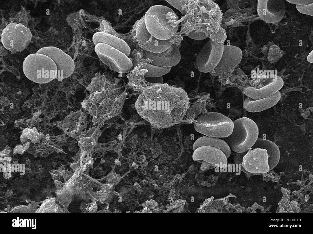 Ce micrographe électronique à balayage (SEM) a représenté un certain nombre de globules rouges qui se sont enmaillés dans une matrice fibreuse sur la surface luminale d'un vasculaire à indwelling; il a été agrandi 2849x. Dans ce cas, le cathéter d'endwelling était un tube qui était laissé en place créant un portail de brevet directement dans un vaisseau sanguin. Certaines érythrocytes sont regroupés en piles appelées formation de routeaux. Notez la forme cytomorologique biconvexe de chaque érythrocyte, qui augmente la surface de ces cellules remplies d'hémoglobine, favorisant ainsi un plus grand degré d'échange de gaz, qui est leur fonction principale Banque D'Images