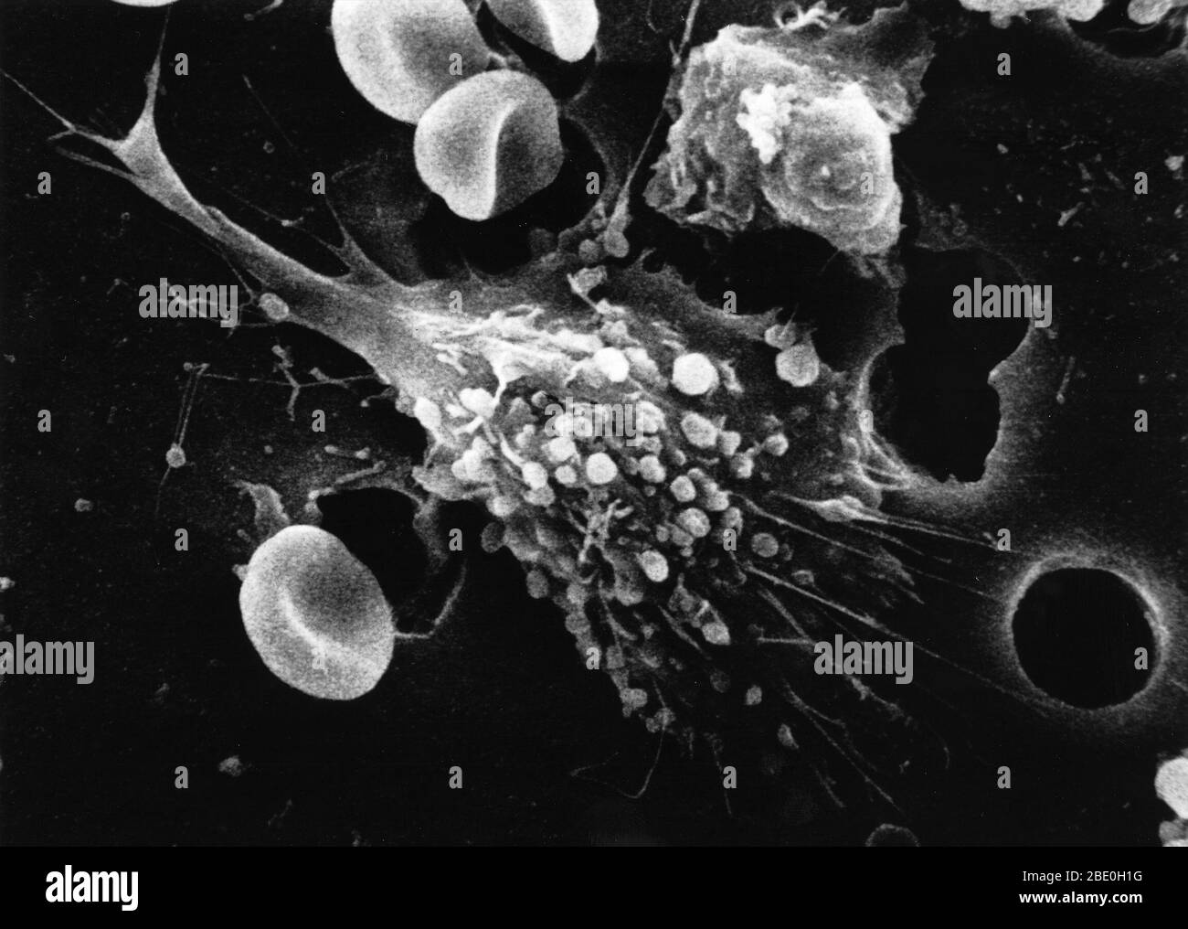 Étape un d'une séquence en six étapes de la mort d'une cellule cancéreuse. Une cellule cancéreuse a migré à travers les trous d'une membrane recouverte par une matrice du haut vers le bas, simulant la migration naturelle d'une cellule cancéreuse envahissante entre, et parfois par, l'endothélium vasculaire. Remarquez les pics ou pseudopodes caractéristiques d'une cellule cancéreuse envahissante. Agrandissement de la photo : 12 000 fois Banque D'Images