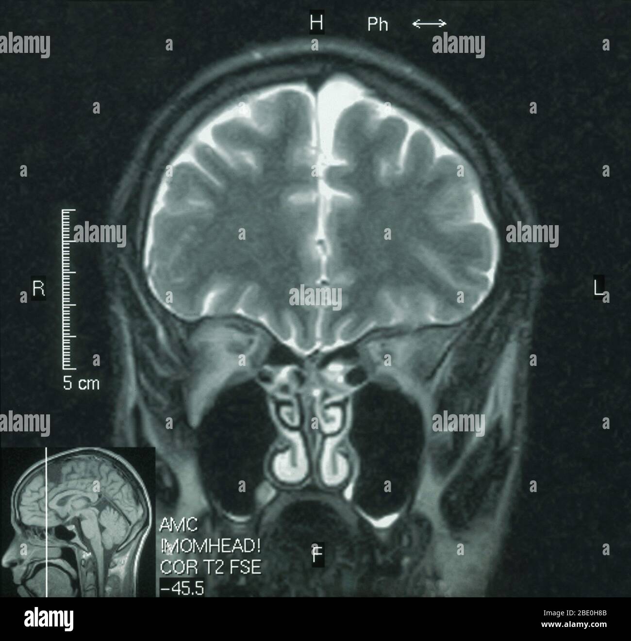 IRM du cerveau (vue sagittale) d'un homme de 26 ans. L'IRM a été prise à la suite de blessures à la tête dans un accident de voiture. Le diagnostic de l'IRM est un petit kyste arachnoïde dans la région frontale antérieure gauche paraparasagittale. Tous les autres aspects semblent normaux. Banque D'Images IRM du cerveau (vue sagittale) d'un homme de 26 ans. L'IRM a été prise à la suite de blessures à la tête dans un accident de voiture. Le diagnostic de l'IRM est un petit kyste arachnoïde dans la région frontale antérieure gauche paraparasagittale. Tous les autres aspects semblent normaux. Banque D'Images