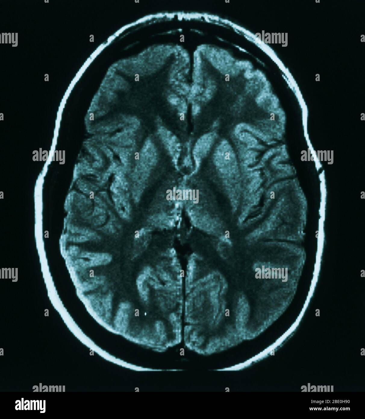 Acquisition IRM (vue axiale) dans le cerveau d'une femme de 31 ans. L’IRM est normale. Banque D'Images