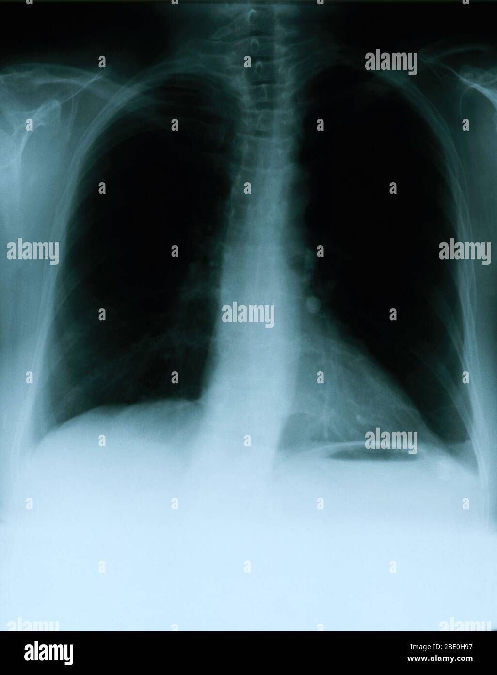 Ganglion Lymphatique Banque D Image Et Photos Alamy