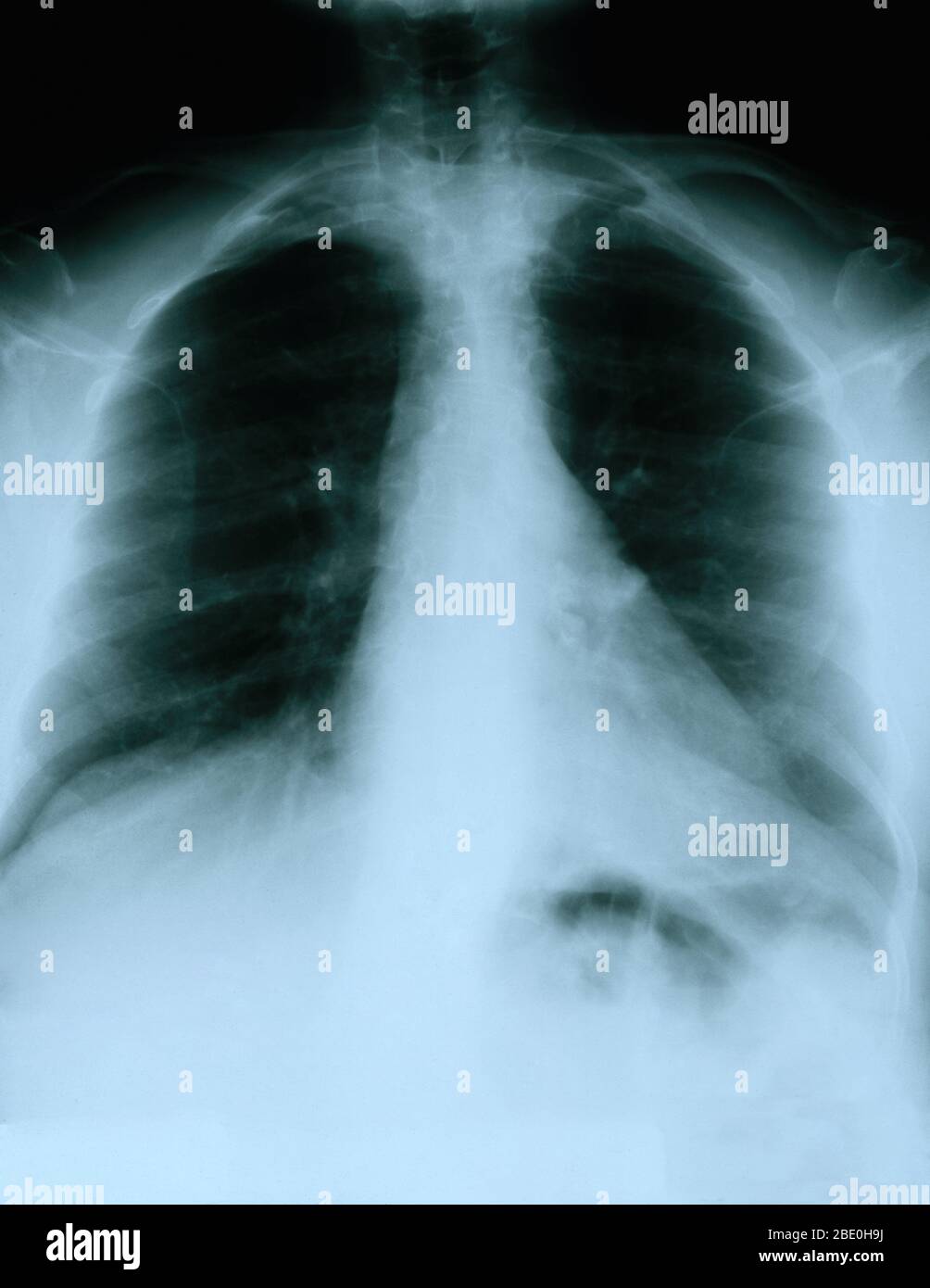 Radiographie montrant une vue frontale de la poitrine d'une femme de 54 ans. La radiographie montre un nœud lymphatique hilaire gauche calcifié qui résulte probablement d'une maladie granulomateuse antérieure. On remarque également une zone vague de densité accrue dans l'aspect latéral de l'apex droit et une déformation scoliotique légère de la colonne vertébrale dorsale. Banque D'Images