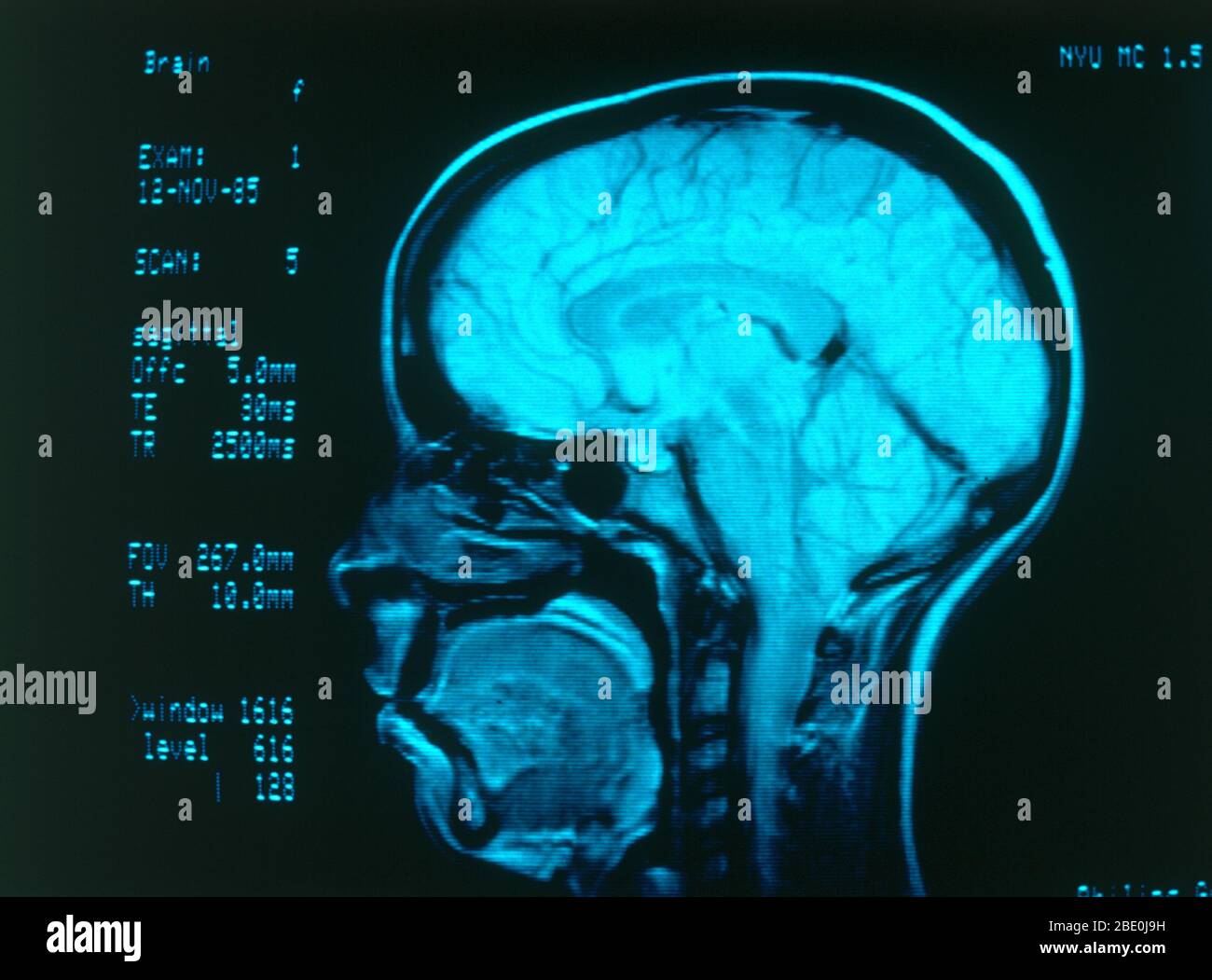 Angiographie en radiologie médicale montrant des vaisseaux sanguins normaux dans le cerveau. Banque D'Images