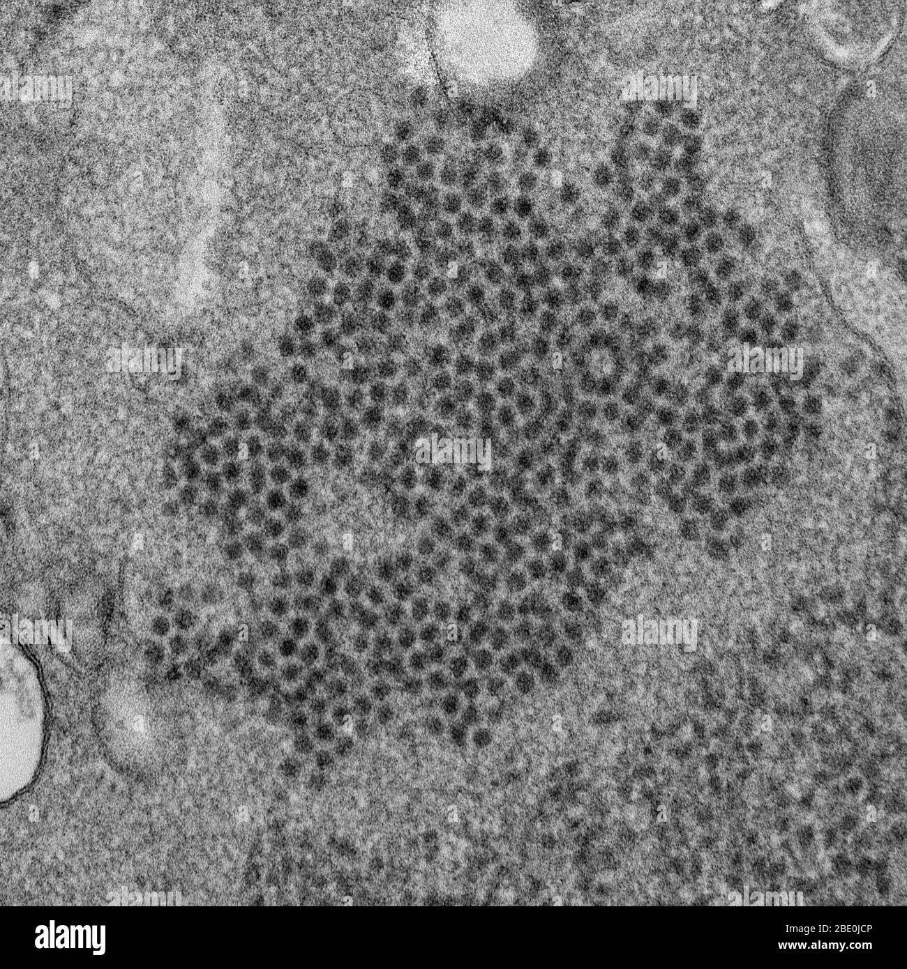 Le micrographe électronique de transmission (TEM) révèle de nombreuses visions de l'entérovirus 68 en forme de sphéroïde (EV68, EV- , HEV68) qui font partie de la famille des Picornaviridae, un entérovirus. Isolé pour la première fois en Californie en 1962 et considéré comme rare, il a été sur un essor mondial au XXIe siècle. Avec une certaine incertitude, il a été impliqué dans des cas de trouble semblable à la poliomyélite, appelé myélite aiguë flaccique. La myélite aiguë flaccique (AFM) est une maladie neurologique d'apparition soudaine chez les enfants. Il présente une faiblesse localisée des membres de cause inconnue. Entérovirus 68, qui en tant que membre de l'entrée Banque D'Images