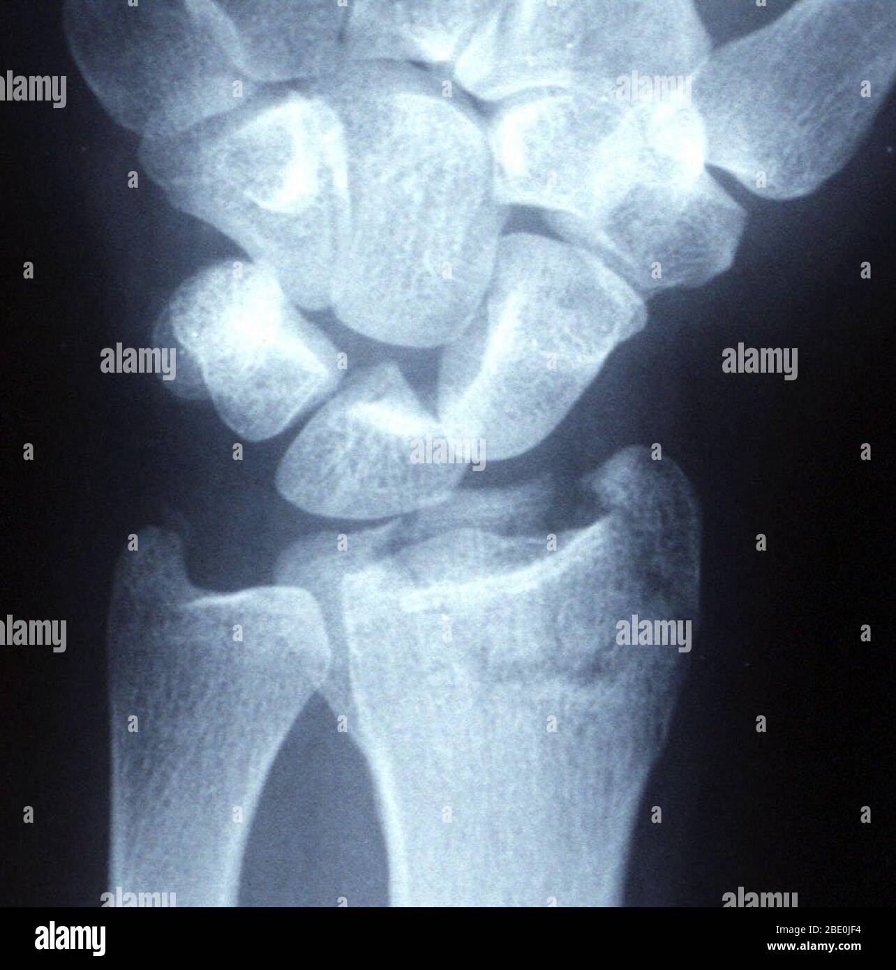 Rayons X d'une fracture distale intra-articulaire déplacée (poignet cassé) dans un fixateur externe. Banque D'Images