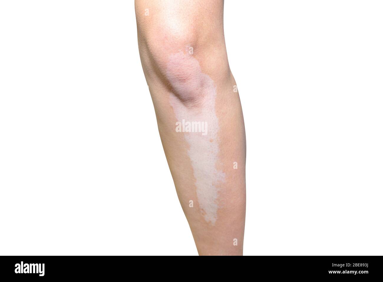 Taches de la maladie de vitiligo sur une jambe dans une jeune ...