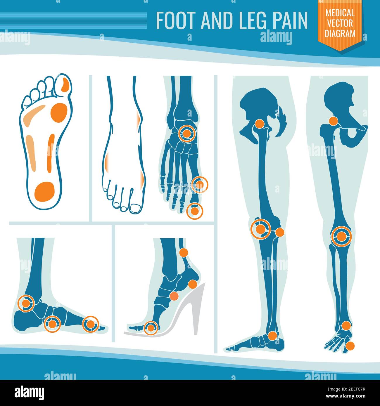 Douleur au pied et aux jambes. Arthrite et rhumatisme diagramme vectoriel médical orthopédique. Illustration de l'articulation des jambes rhumatismales Illustration de Vecteur