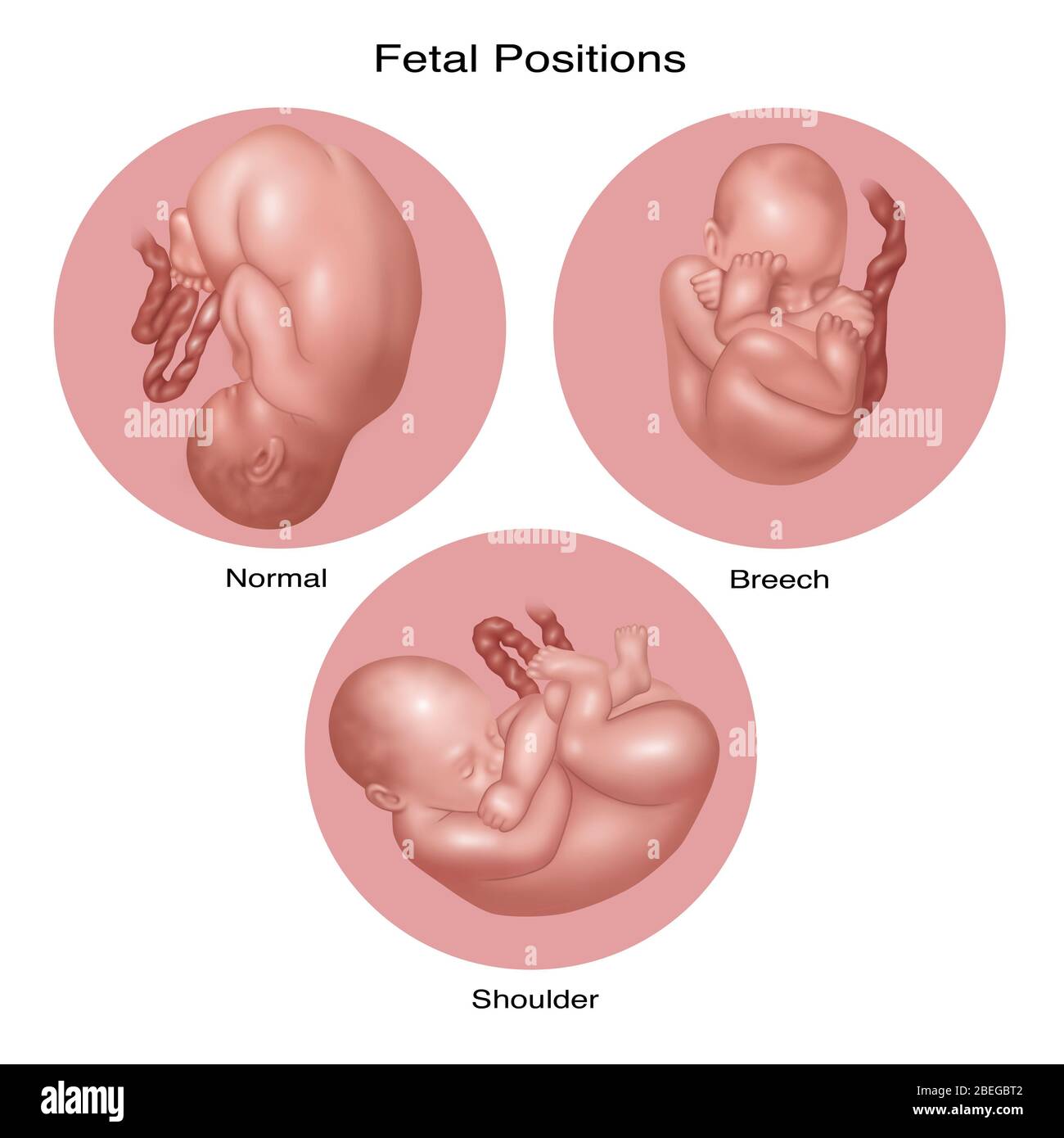 Breech Position Banque D Image Et Photos Alamy