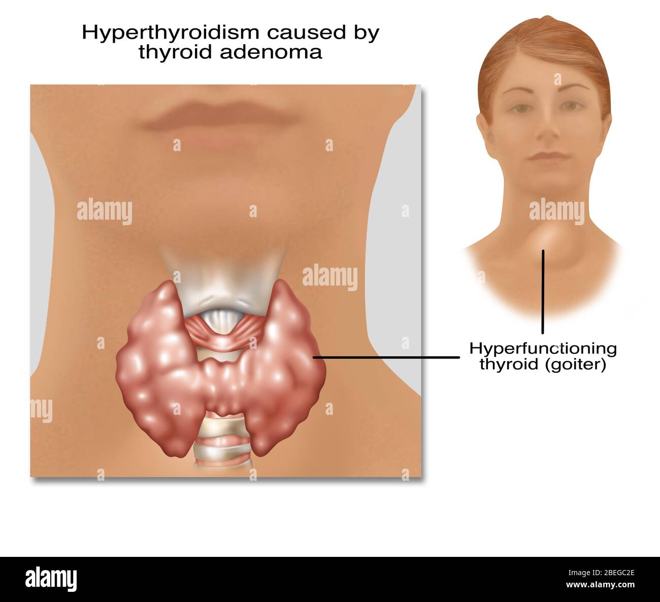 Hyperthyroïdie, illustration Banque D'Images