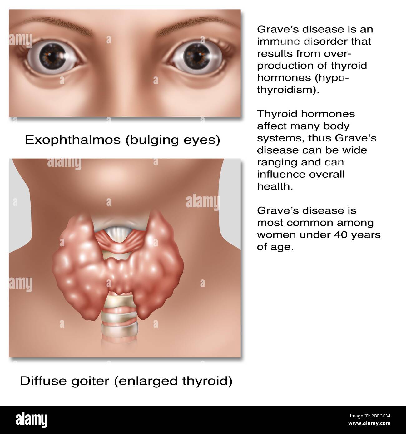 La maladie des tombes est un trouble immunitaire qui résulte de la surproduction d'hormones thyroïdiennes (hyperthyroïdie). Les hormones thyroïdiennes affectent de nombreux systèmes corporels, donc la maladie des tombes peut être de grande envergure et peut influencer la santé globale. Cette illustration montre deux symptômes communs de la maladie, exophtalmie ou buleux yeux et une thyroïde élargie (goitre). La maladie des tombes est la plus fréquente chez les femmes de moins de 40 ans. Banque D'Images