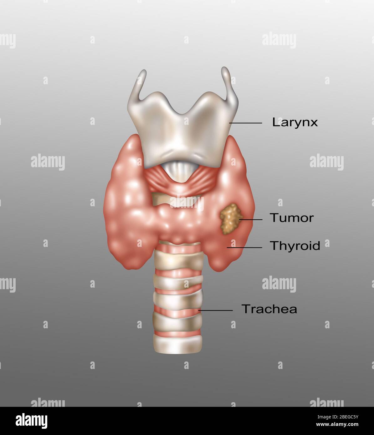 Illustration montrant l'emplacement du larynx, de la glande thyroïde et de la trachée. Une croissance maligne peut être observée dans la partie inférieure droite de la thyroïde. Banque D'Images