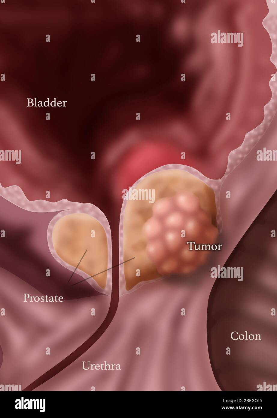 Le cancer de la prostate, illustration Banque D'Images