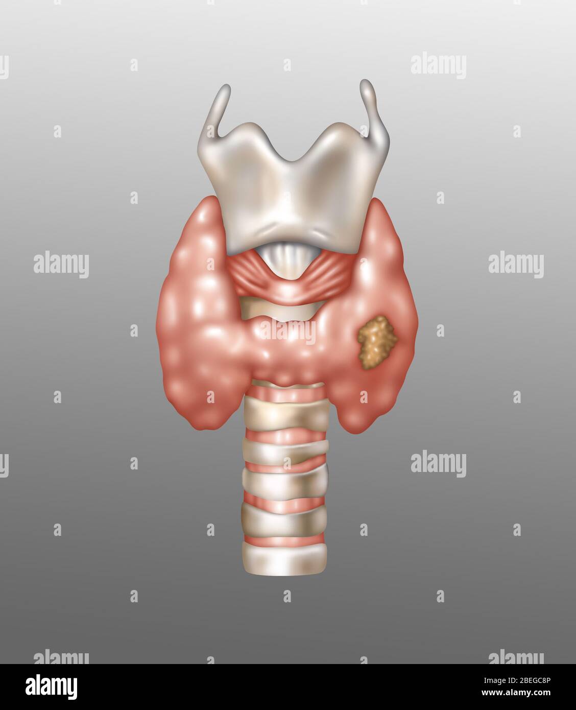Cancer de la thyroïde, Illustration Banque D'Images