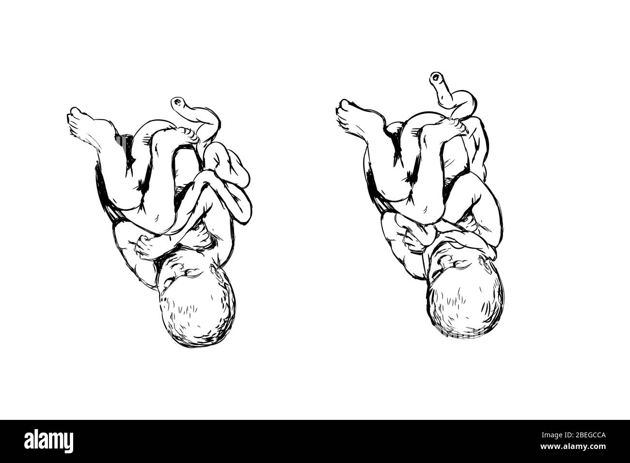 Illustration montrant un bébé avec cordon nucal (le cordon ombilical enveloppé autour du cou), condition qui peut potentiellement causer des complications à la naissance, telles que l'asphyxie. Banque D'Images