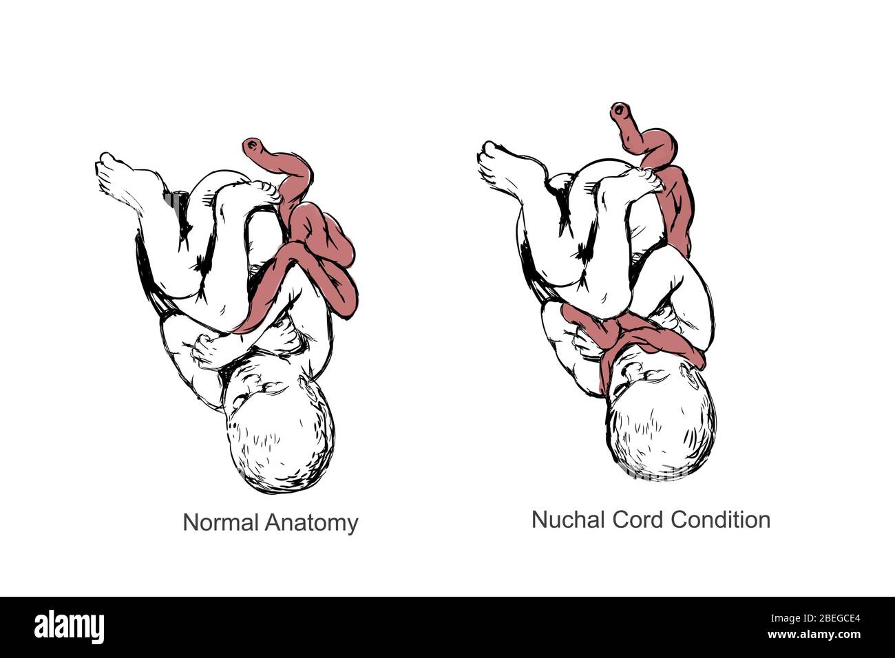 Cordon nucal et Asphyxie de naissance, illustration Banque D'Images