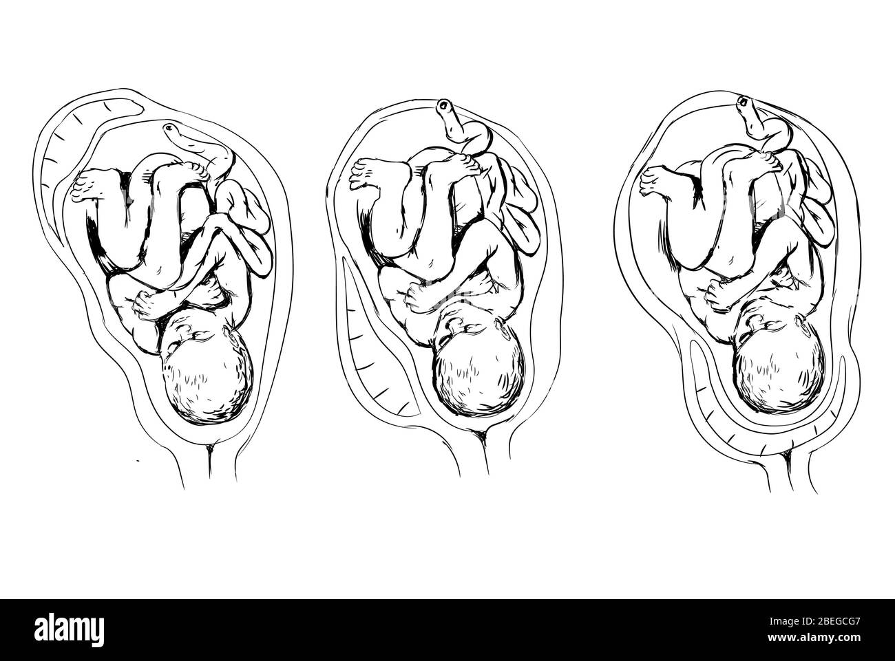 Placenta Previa, Illustration Banque D'Images