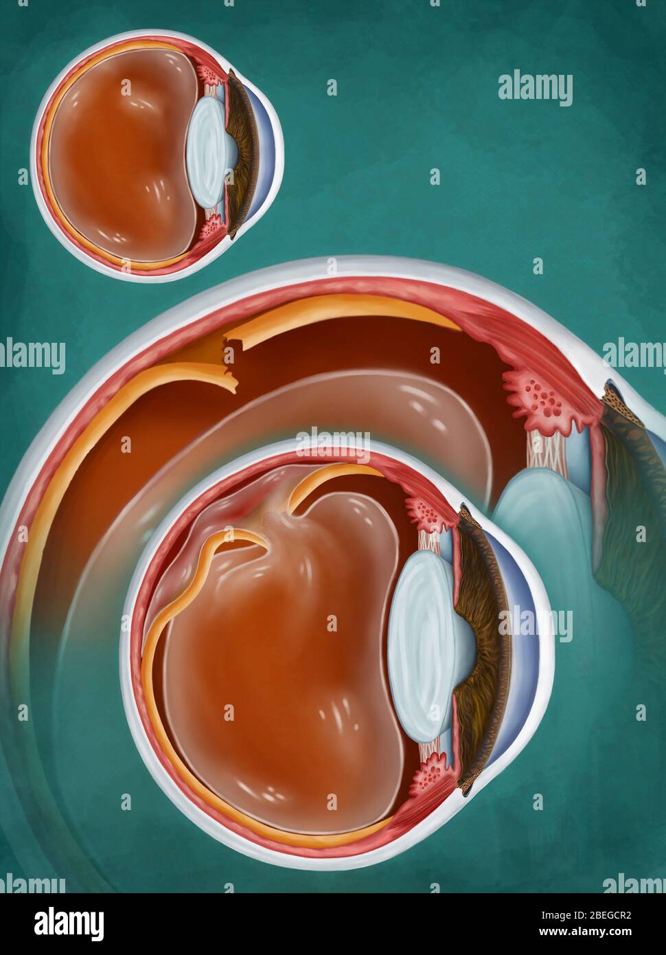 Retina détaché, illustration 2 D. Banque D'Images