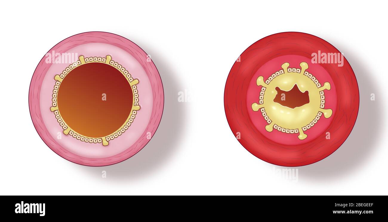 Bronchite Banque D'Images