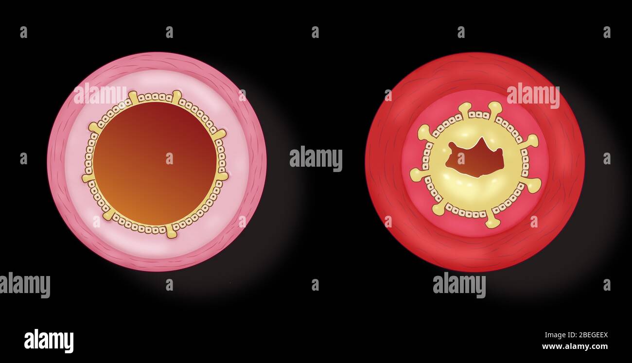 Bronchite Banque D'Images