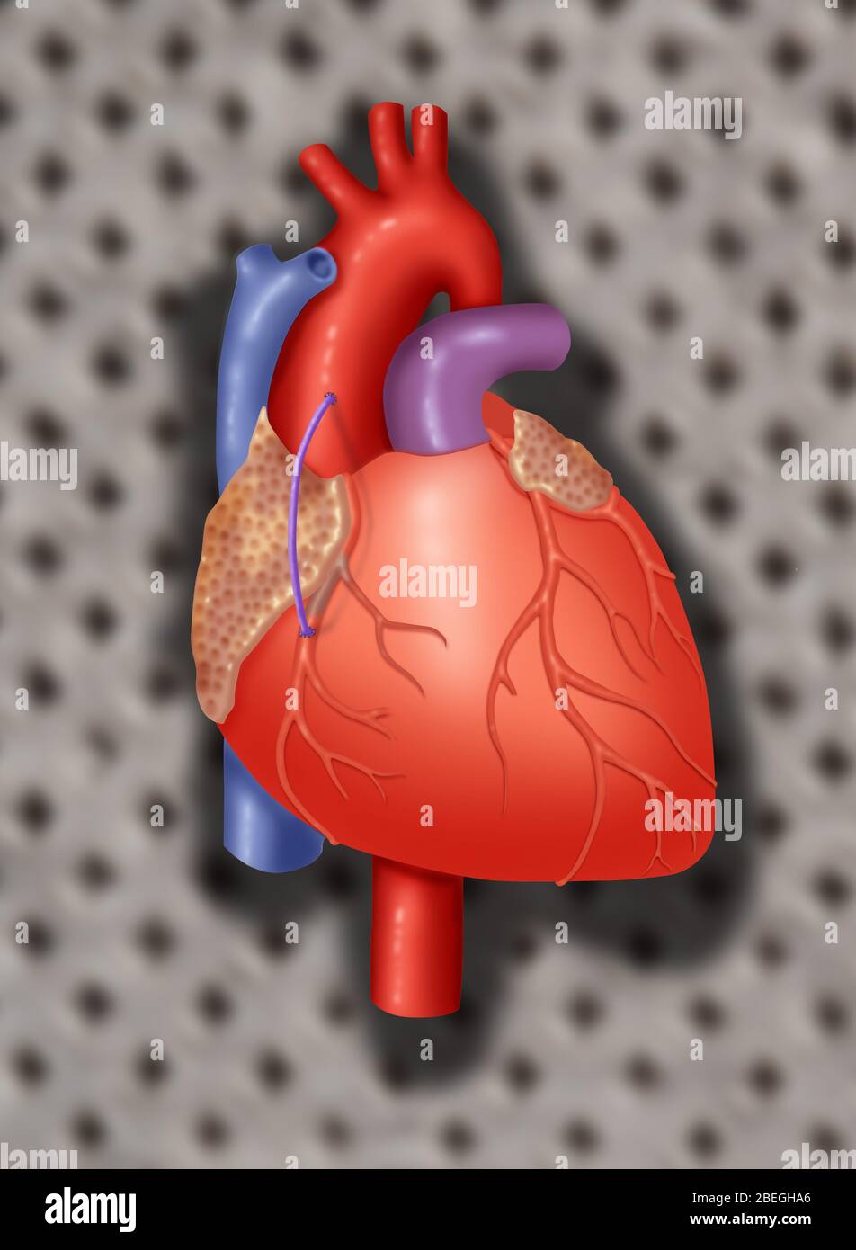 Radeau de veine coronaire Banque D'Images