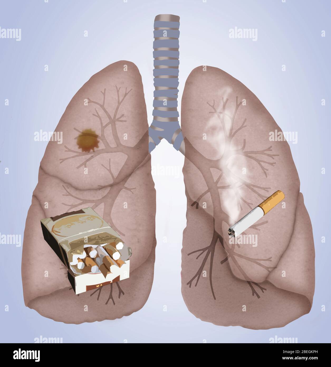 Cancer du poumon Banque D'Images