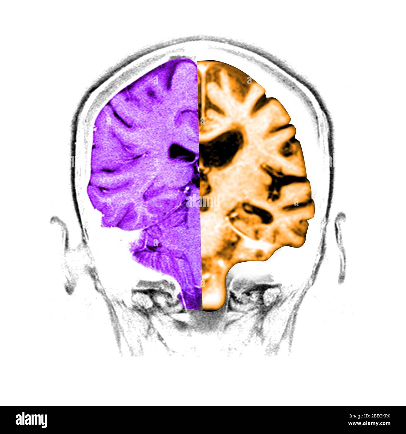 Comparaison normale / cerveau d'Alzheimer Banque D'Images