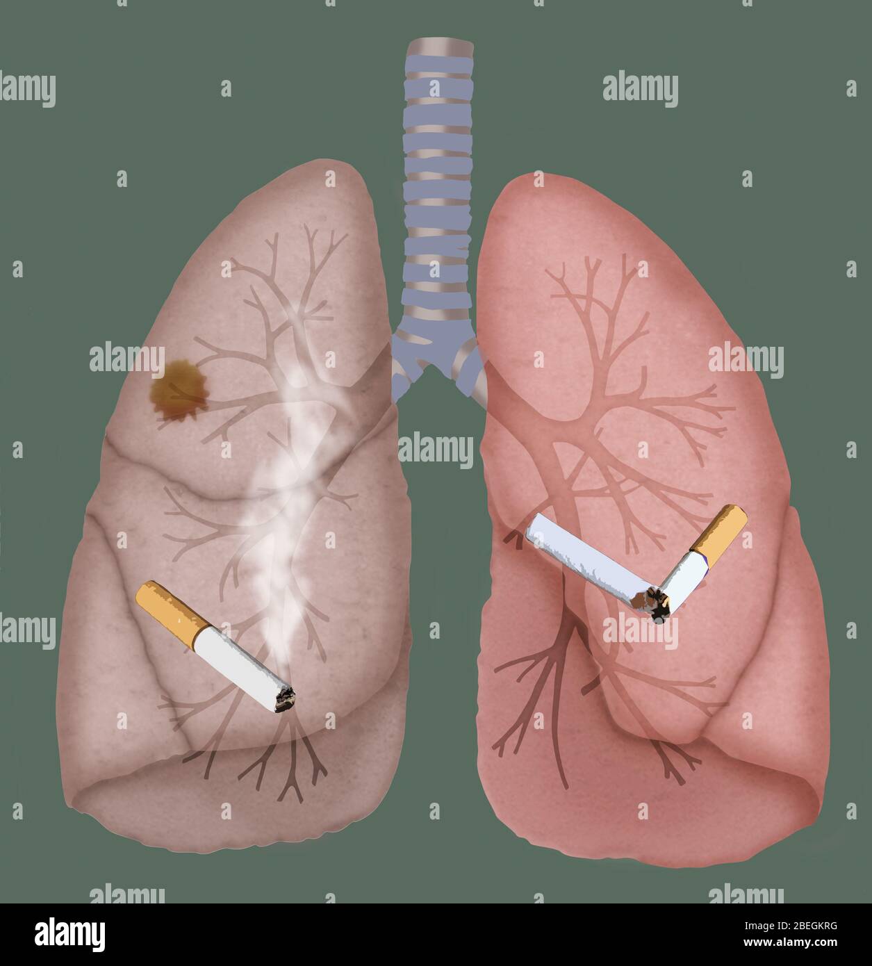 Poumons sains et cancéreux Banque D'Images