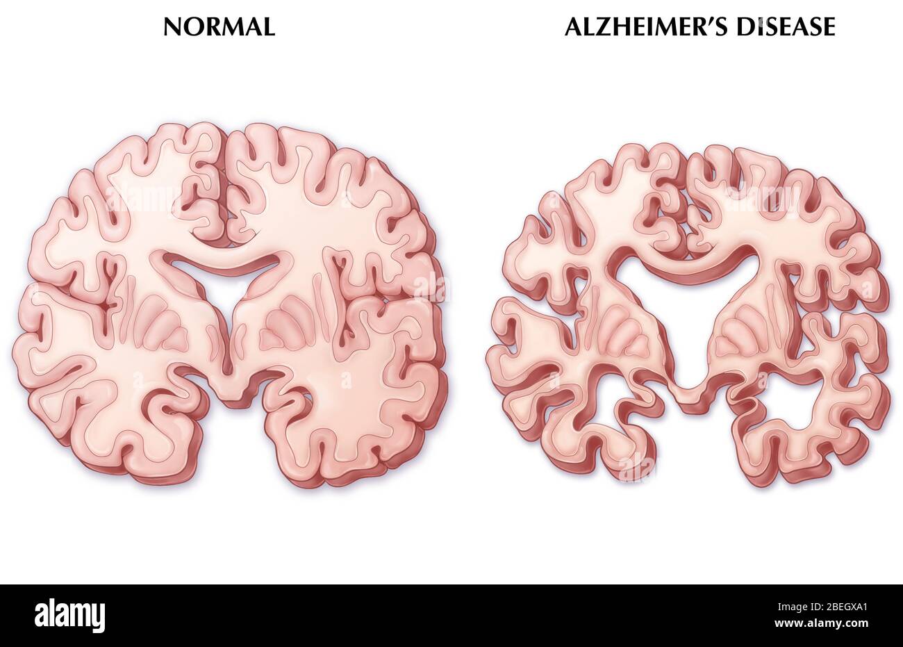 Comparaison des cerveau de la maladie d'Alzheimer Banque D'Images