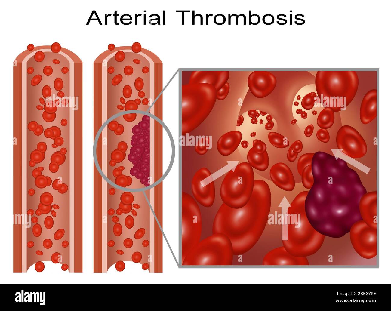 Thrombose artérielle et embole Banque D'Images