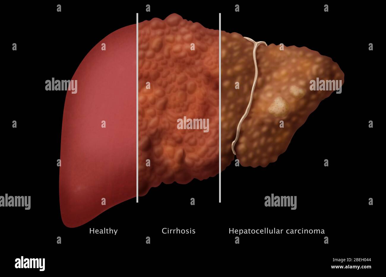 Comparaison du foie Banque D'Images