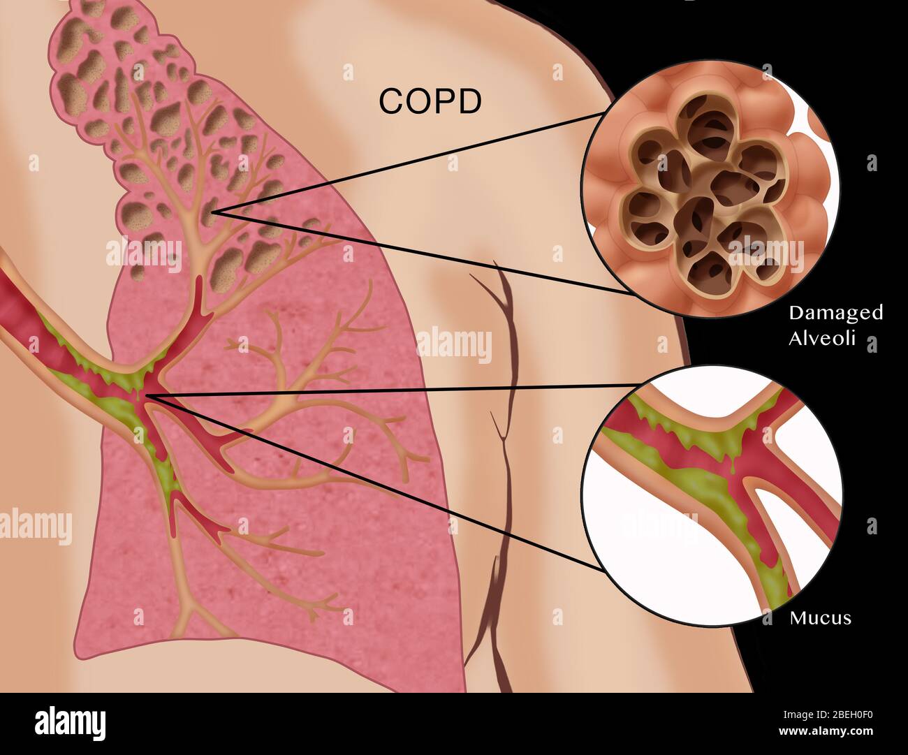 Maladie pulmonaire obstructive chronique Banque D'Images