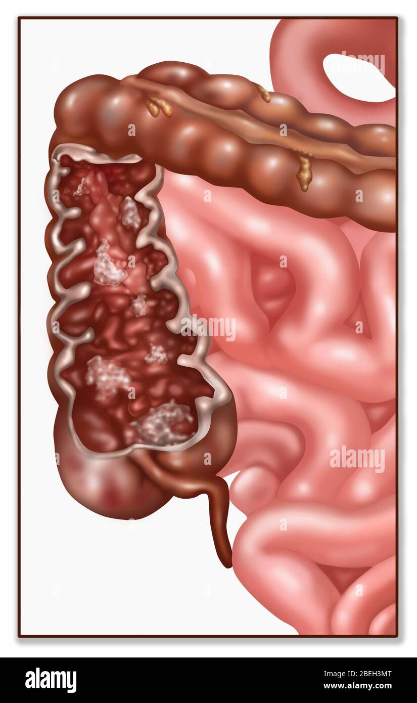 Maladie de Crohn, DCI, Illustration Banque D'Images