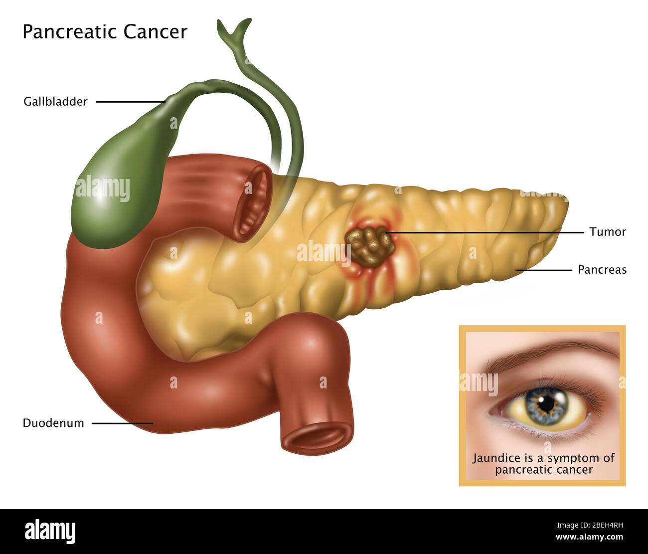 Quels Sont Les Signes D'un Cancer De La Vésicule Biliaire Cancer de la vésicule biliaire Banque d'images détourées - Alamy