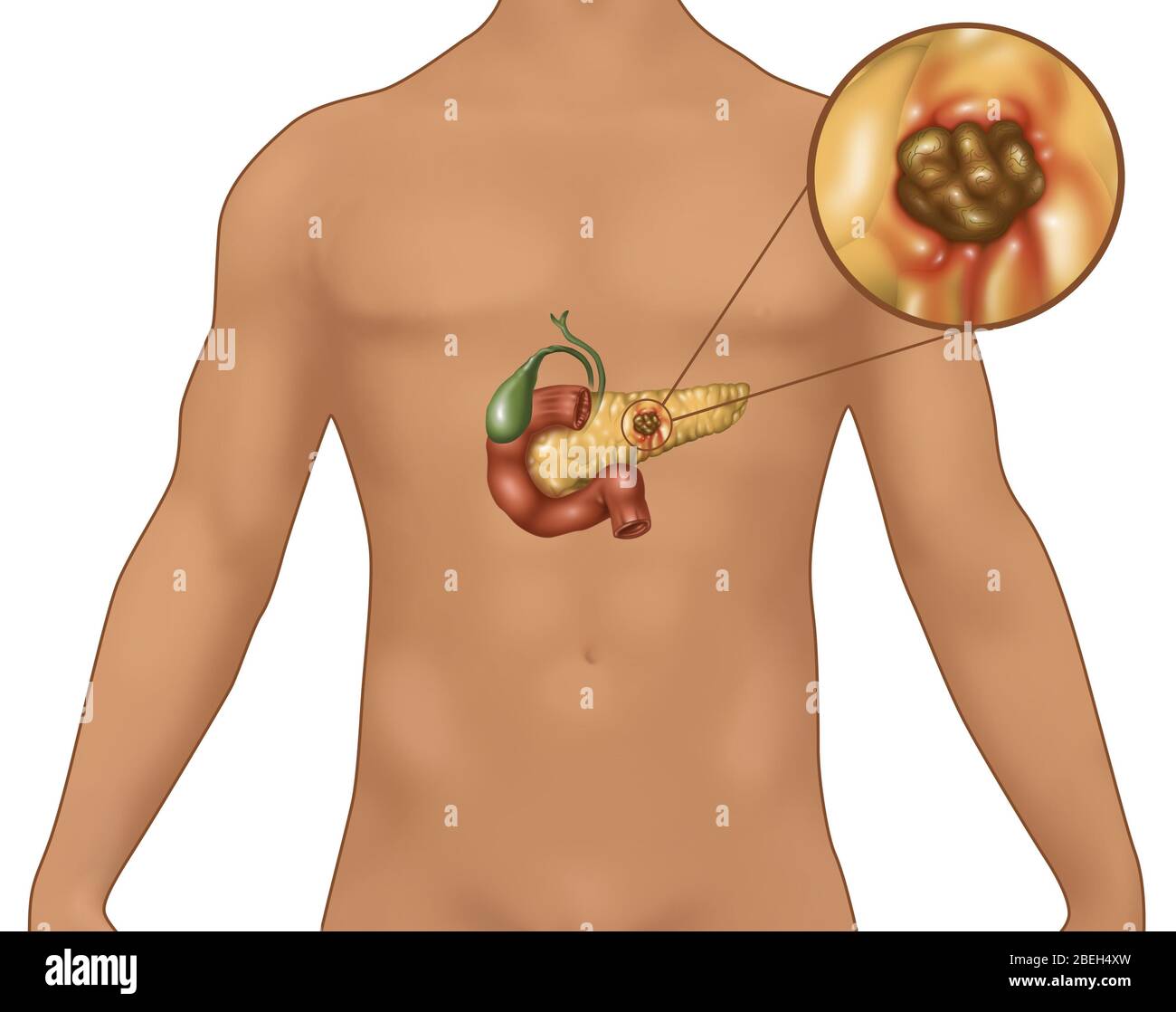 Cancer du pancréas chez les hommes Figure, Illustration Banque D'Images