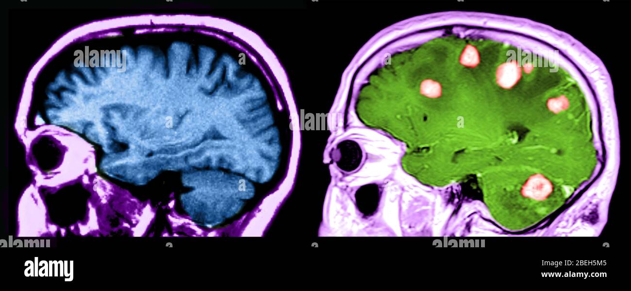 IRM des cerveaux, normal et avec tumeurs malignes Banque D'Images