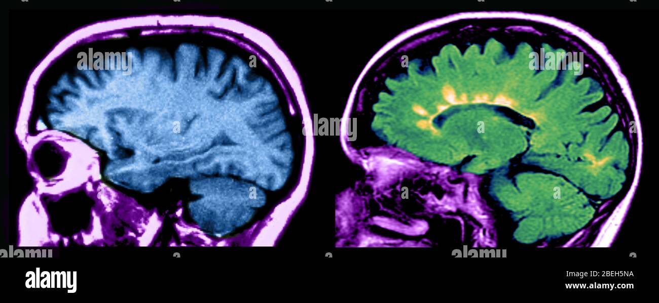 IRM des lésions cérébrales normales et de la sclérose en plaques Banque D'Images