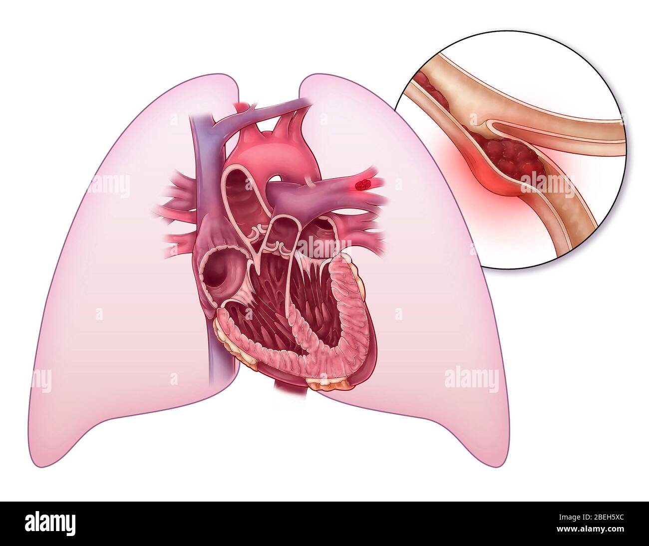 Embolisme pulmonaire, illustration Banque D'Images