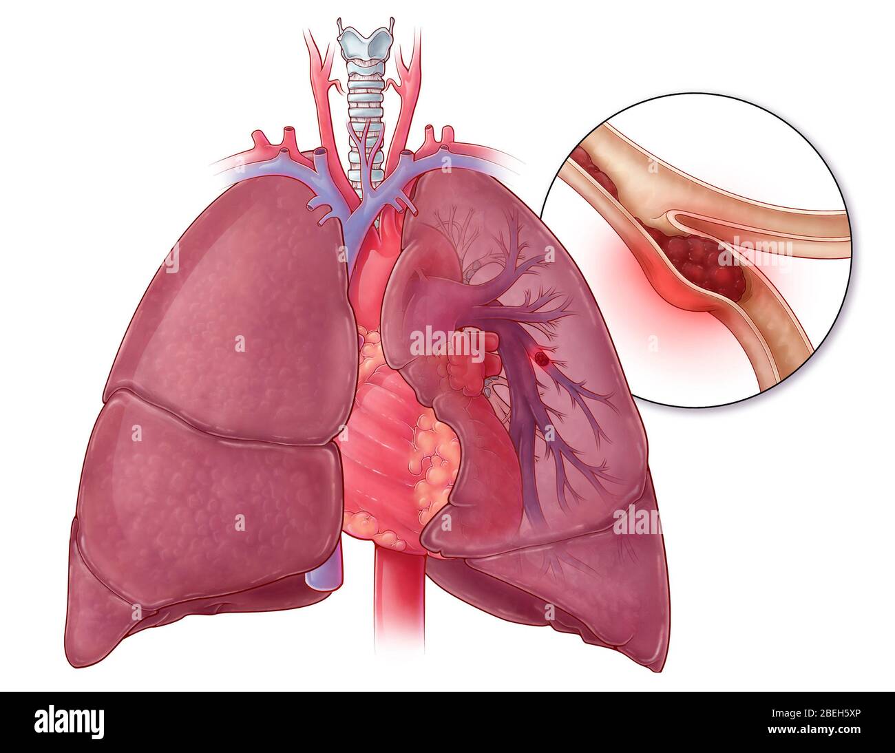 Embolisme pulmonaire, illustration Banque D'Images