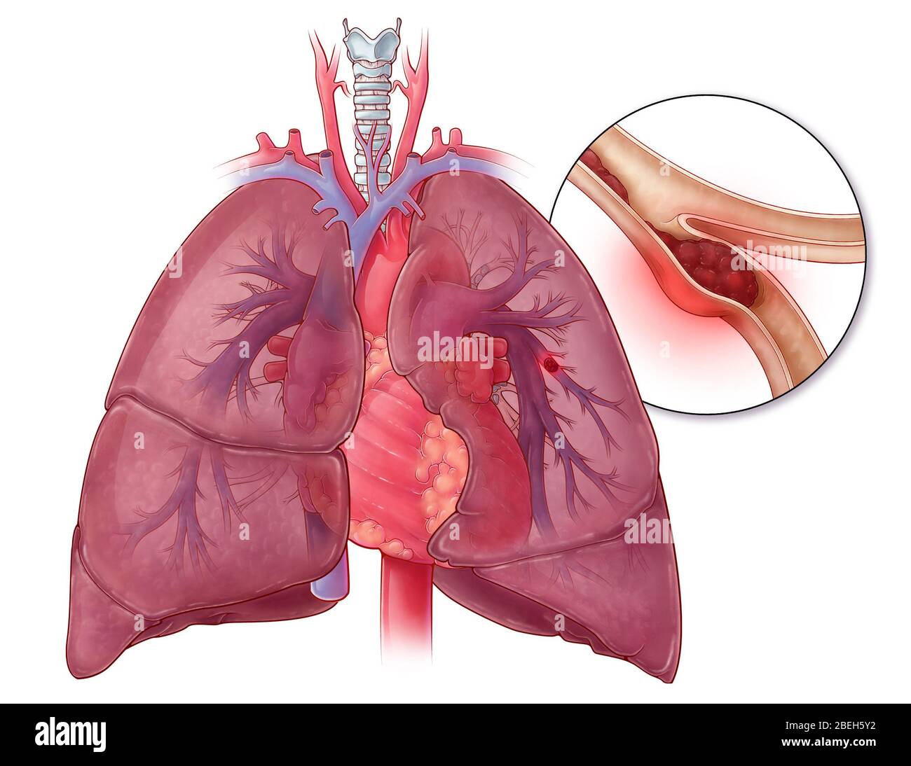 Embolisme pulmonaire, illustration Banque D'Images