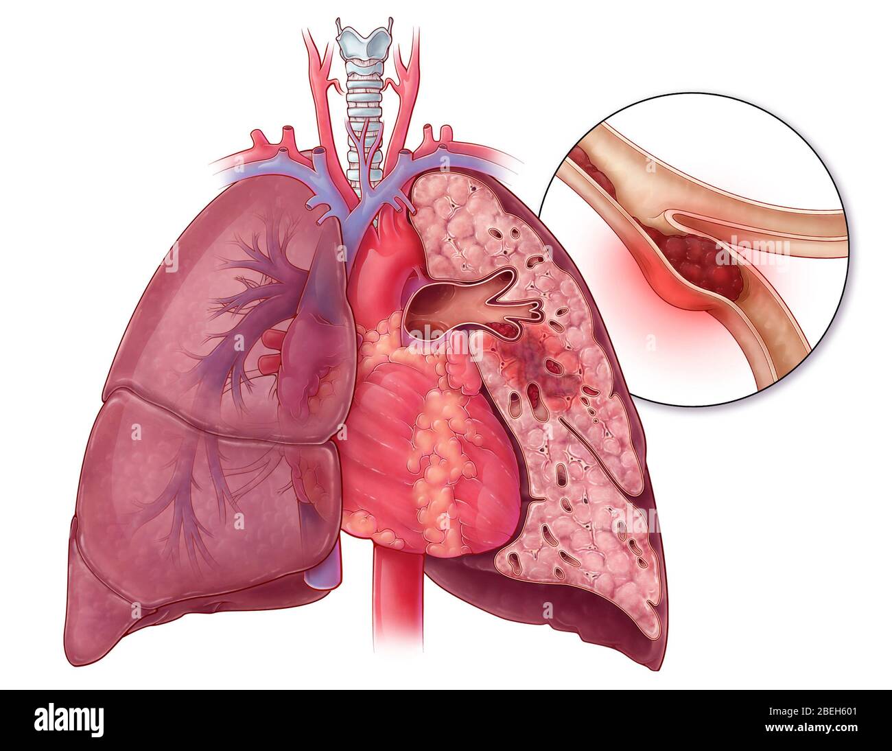 Embolisme pulmonaire, illustration Banque D'Images