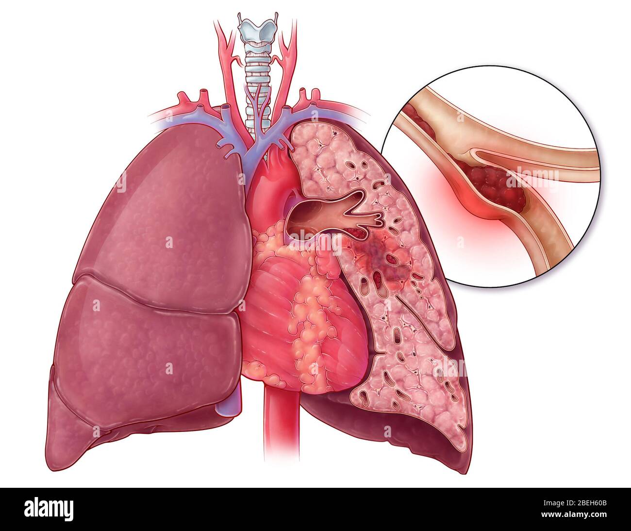 Embolisme pulmonaire, illustration Banque D'Images